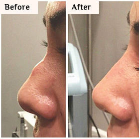 nose reshape with fillers long island